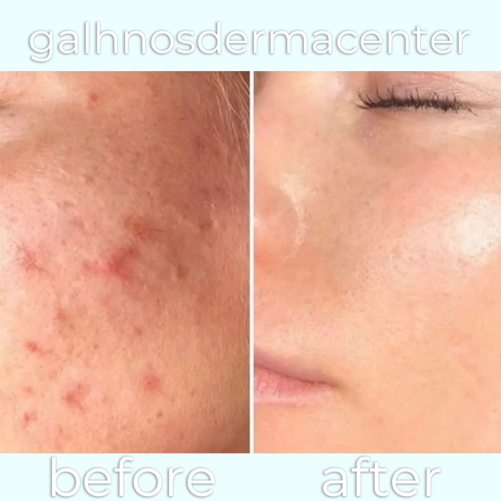 Dermapen-beforeafter