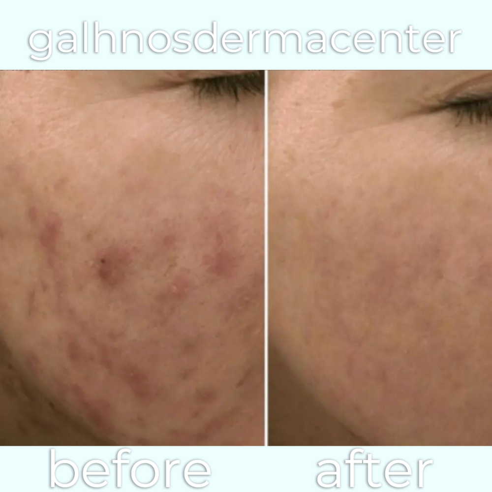 Dermapen_beforeafter