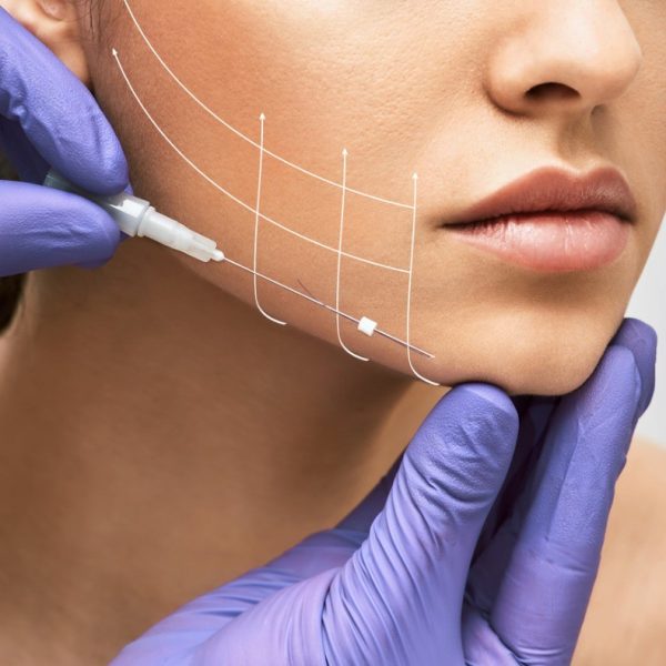 facial-lifting-thread