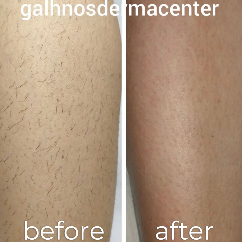 laser_alexandrite_beforeAfter